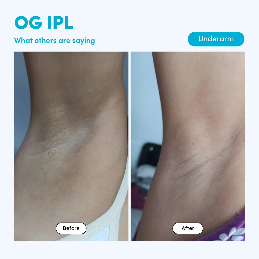 Beauteskin OG IPL