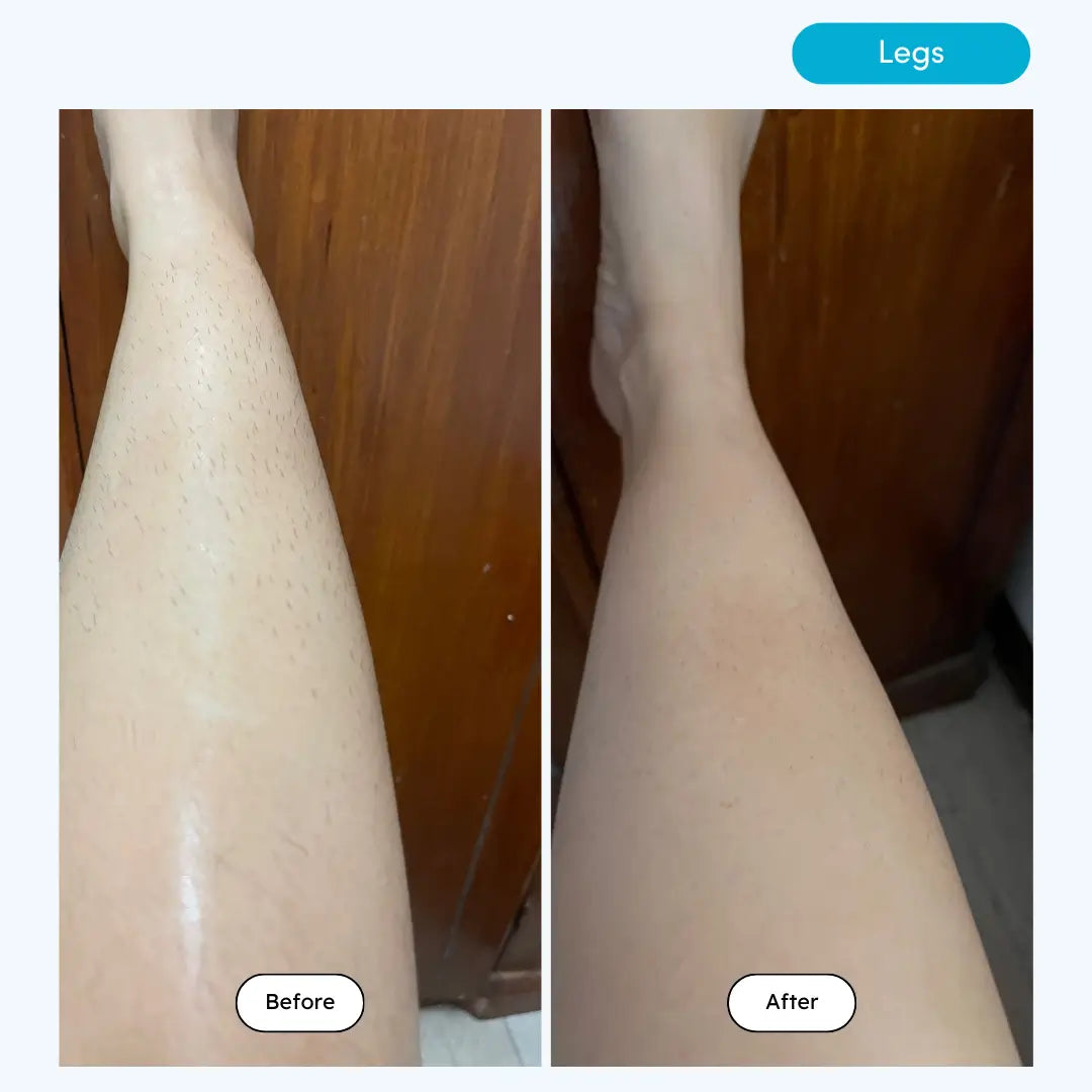 Beauteskin OG IPL