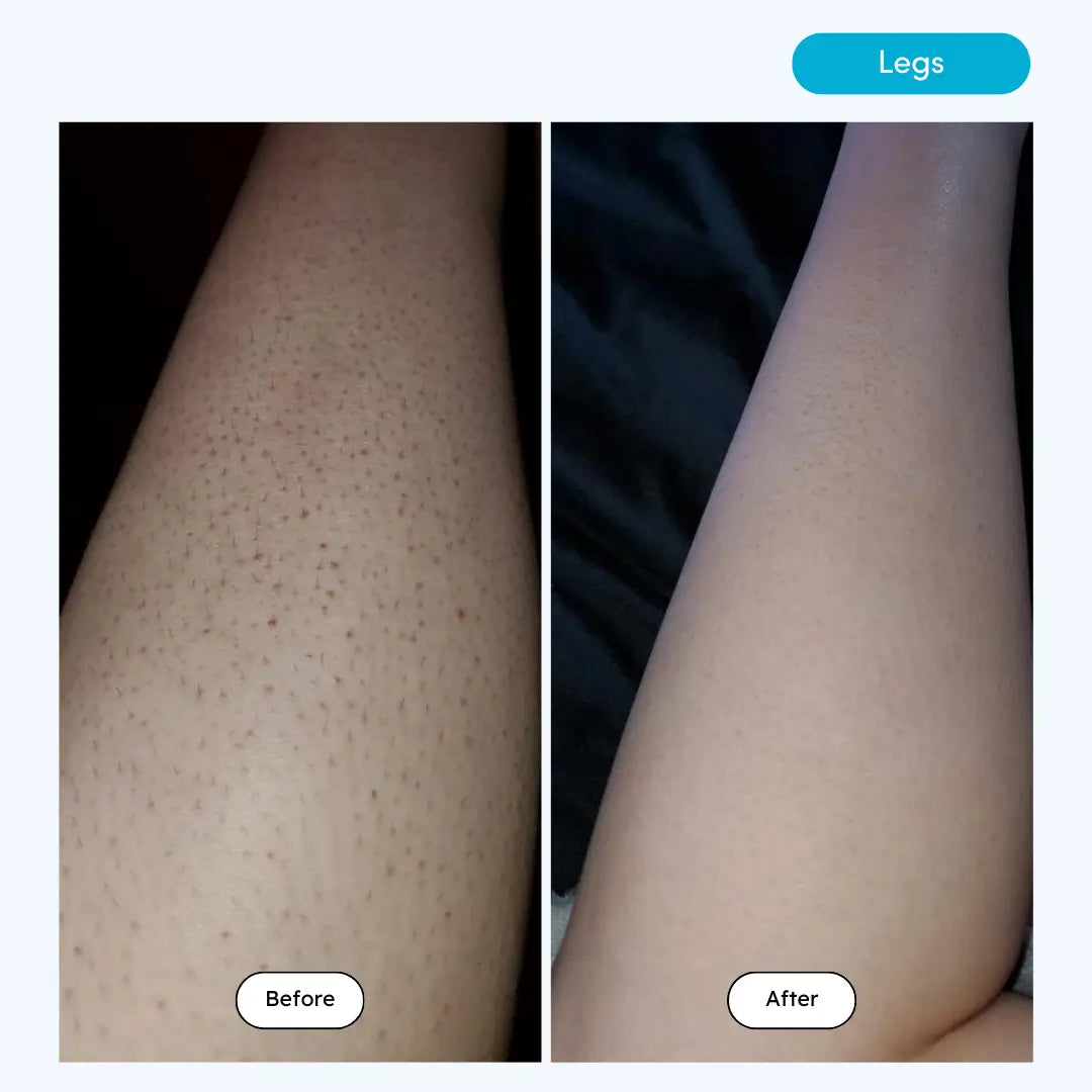 Beauteskin OG IPL